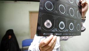 Prepogosti udarci žoge z glavo škodijo možganom