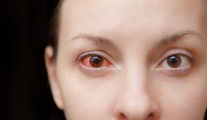 Kaj je vzrok za resne težave z očmi?